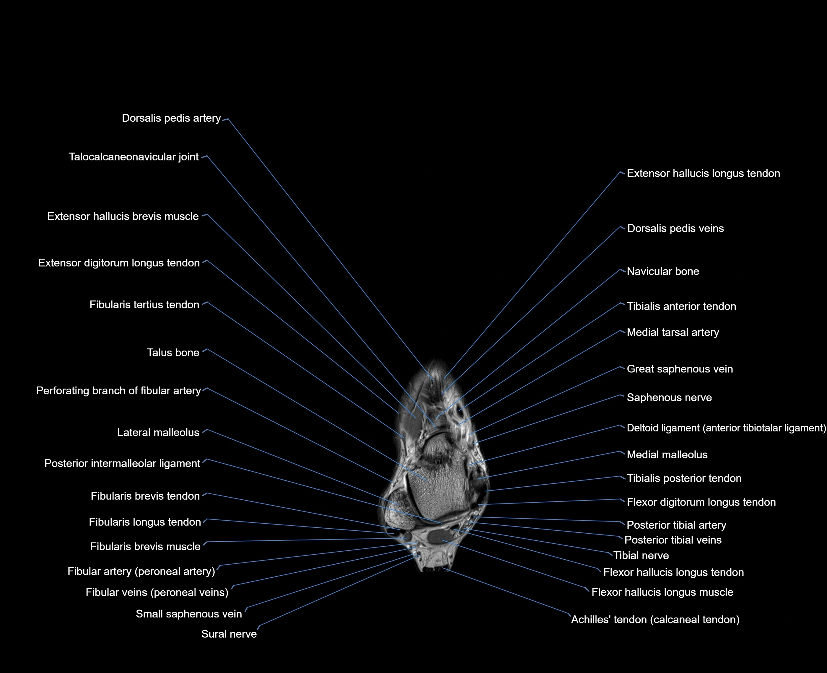 MRI foot coronal cross sectional anatomy 3T  radiology  image-img-00001-00009.webp
